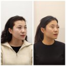 미본 얼굴윤곽관리 강남점 18회차 후기/윤곽관리 일지
