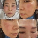 대구예쁨주의쁨의원 필로드부작용 후기