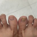 장안19 | 장안동문제성발톱 전문 무좀발톱케어 후기 < 바이오 풋케어 장안점 >