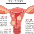 자궁근종 자궁 물혹 원인 통증 진단 이미지