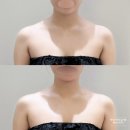 청담에스테틱 리무드 하이퍼소닉 상체 관리 라인개선 후기