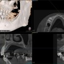 고산치과의원 | 민락동, 임플란트 수술 과정 단계별로 쉽게 설명드립니다.