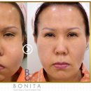 형한의원 | 얼굴 이물질 제거 수준..보니따의원 장난 아니네