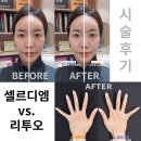 누의원 | 리투오 vs 셀르디엠 "두 가지 모두 받아본 사람의 솔직 비교 후기" #누의원 #피부과 의사가 직접 받아봄!