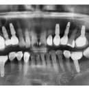 횡성치과의원 | 횡성 임플란트 치과/서울플란트치과/19년차 보철과 전문의 책임진료..양측 상악동 골이식 후 임플란트...
