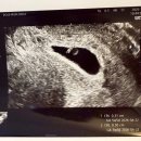 로즈맘산부인과의원 | [임신 6주차] 6주차 초음파 난황, 심장소리 확인(5주차 입덧, 6주차 입덧 증상)