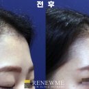 리뉴미피부과의원 네이버블로그