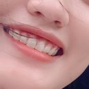 스마일클리어교정치과기공소 | 삼성동치과 과개교합 교정 13개월차, 턱관절 두통 사라짐!