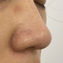 안산감동한의원 | 깊고 큰 모공흉터 치료 끝! 전문 한의원 8회차 후기 비포 애프터