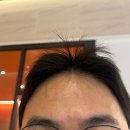 닥터로미성형외과의원 | 이마 &amp; 미간 보톡스 효과 대만족 l 서면성형외과 닥터에버스 서면점