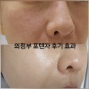 의정부역 | 의정부역피부과 포텐자 전후 효과 후기