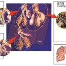 폐기종의 원인과 증상 및 치료 예방법 이미지