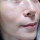엘라비에 리투오 스킨부스터 부작용 없는 2주 후기(가격/효과/통증/붓기/할인정보 등)
