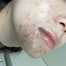 이충로13번길 | 평택 에스테틱 추천-좁쌀 여드름 관리 어디가 좋을까? (로즈아트스킨 vs 디또뷰티 솔직 비교)