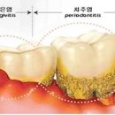 잇몸 부었을때 잇몸염증 치은염 치주염 치주 이미지