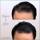 마음에점을찍다두피SMP 이미지