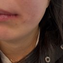 오성병원 | 대구 시지 오성치과 사랑니 발치 후기