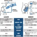 신부전(腎不全)에 복막투석(腹膜透析), 환자 스스로 자택에서 가능 이미지