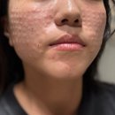 신대피부과 | 홍대피부과 여름철 피부 관리 자외선으로 자극받은 피부 저통증 프리미엄 리쥬란 3cc 후기