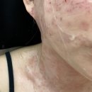 허에스테틱 | 동탄 편평사마귀 제거 : 허니블리 에스테틱 내돈내산 후기♥