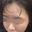 대세통상 | 리쥬란힐러 + 물광주사 수면마취 후기 / 속건조 효과, 엠보싱, 유지기간