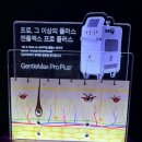 프로 | 강남 레이저 제모 젠틀맥스프로플러스 후기