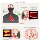 뇌졸중 이미지