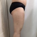 안나메디칼 | 지흡) 7. 지방흡입 2차수술 후 ~2주차~ 후기