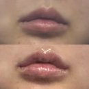 에버샘의원 입술필러 후기, 얇아진 윗입술 입술산 볼륨 자연스럽게 살리기