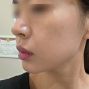 미작뷰티 일산점 I 고양시 삼송 기미잡티제거 후기