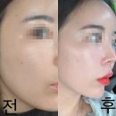 가나상사 | 로데오 피부과 스킨바이브1cc+물광주사2cc솔직후기 통증, 엠보, 다운타임, 효과, 부작용,주의사항, 시술...