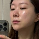 서울이내과의원 | [강남 에르네의원] 피부탄력개선 엘라비에 리투오 7cc 후기 (통증, 전후사진有)