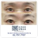 모차르트성형외과의원 | 꺼진눈지방이식 부작용 없는 눈꺼풀 시술 후기
