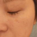 줌커피 | 구월동피부과 기미레이저 피코토닝 줌패스 1회차 효과 후기