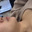 엑셀 | 압구정로데오역 피부과 엑셀웨이브 효과 본 후기