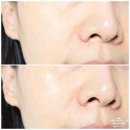 수축 | 쿠피 아줄렌 니들샷 모공수축 크림 후기 단 1회 사용으로 달라진 모공 케어