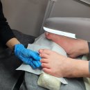 평촌 내성발톱을 레푸스 군포산본점 오블리네일 추천받아 치료 만족한 후기