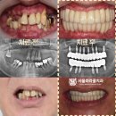 박현수치과의원 | 잇몸질환을 방치하면 안되는 이유, 군포 치과 에서 설명드리겠습니다. (상악동 거상술 및 골이식을 동반...