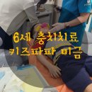 6세 충치치료 미금키즈파파에서