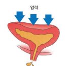 복압성 요실금 원인 케겔운동 효과 이미지