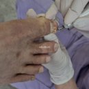 [공지] 부산발톱무좀 부산내성발톱 부산레푸스연산시청점