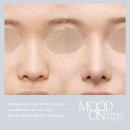 방패의원 | 비중격이 부족했던 첫코성형 케이스, 자가늑 코수술로 해결