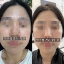 결혼 준비 피부관리로 홍대 한의원에서 약초침 관리 후기 2회차