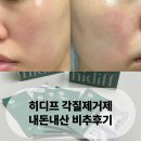 진소프트 | 히디프 로얄 소프트 클린 키트 2회 사용 | 민감성 피부 비추 후기
