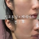 (주)나루스튜디오 | 마곡나루피부과 피코토닝 제네시스 홍조 레이저 광대보톡스 후기