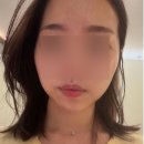 압구정튠의원 | 유라인클리닉 윤곽주사 5회차 전후 비교 후기