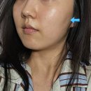 수원시청 | 수원시청역피부과 쥬베룩볼륨 효과 후기