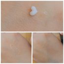 진한의원 | 편평사마귀 한의원 돈 엄청 깨집니다 (진후기)