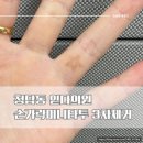 미니휴게점 | [서울/강남구] 청담동 읻다의원 :: 손가락 미니 타투 3차 제거 후기!