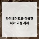 서울루다치과의원 | 라미네이트를 이용한 치아 교정 사례